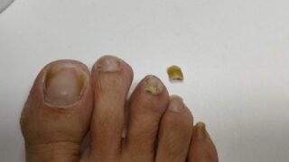 爪水虫を熱湯で退治するのは本当？ 熱湯治療のメリットとデメリット